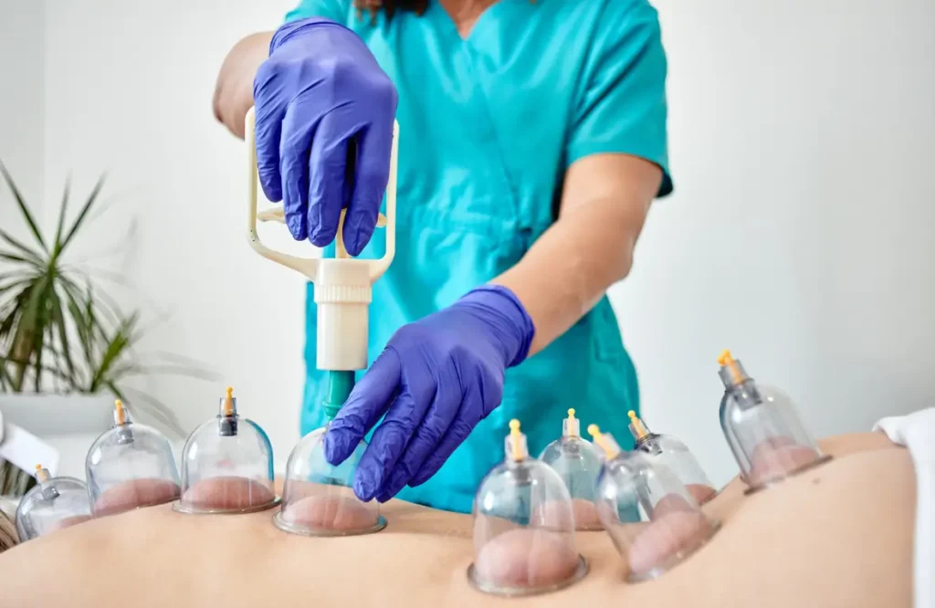Cupping Therapy