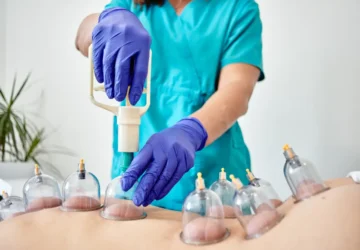Cupping Therapy
