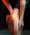Signs & Symptoms of an ACL Tear