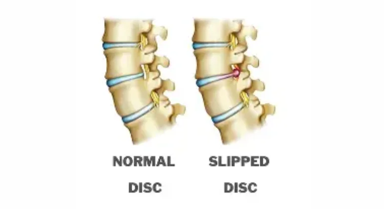 Key Benefits of Home Physiotherapy for slip Disc