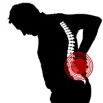 Home Physiotherapy for Sciatica