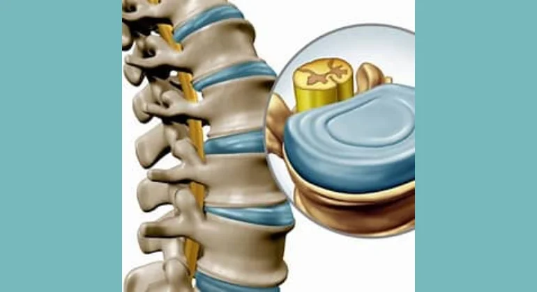 physical therapy to treat slip discs