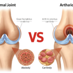 Does Knee Cracking Mean Arthritis