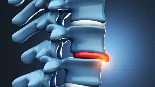 स्लिप डिस्क क्या है? लक्षण, कारण और फिज़ियोथेरेपी से इलाज