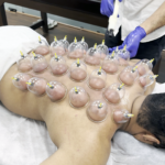 Cupping Therapy