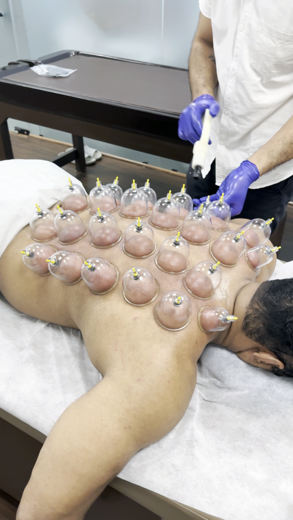 Cupping Therapy के फायदे और कैसे काम करती है?
