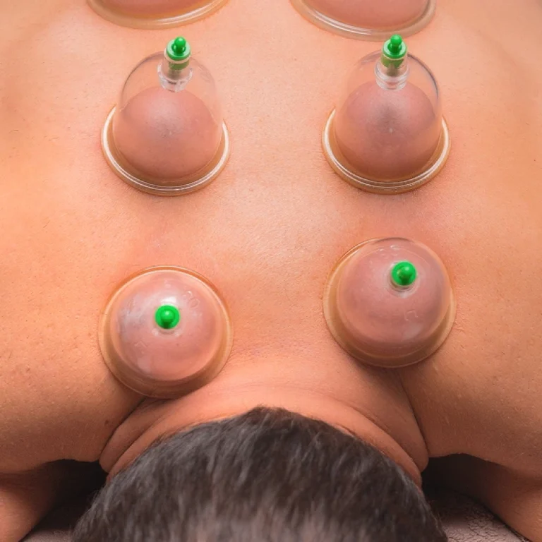 Cupping Therapy at Home A Natural Way to Heal Without Leaving Your Room