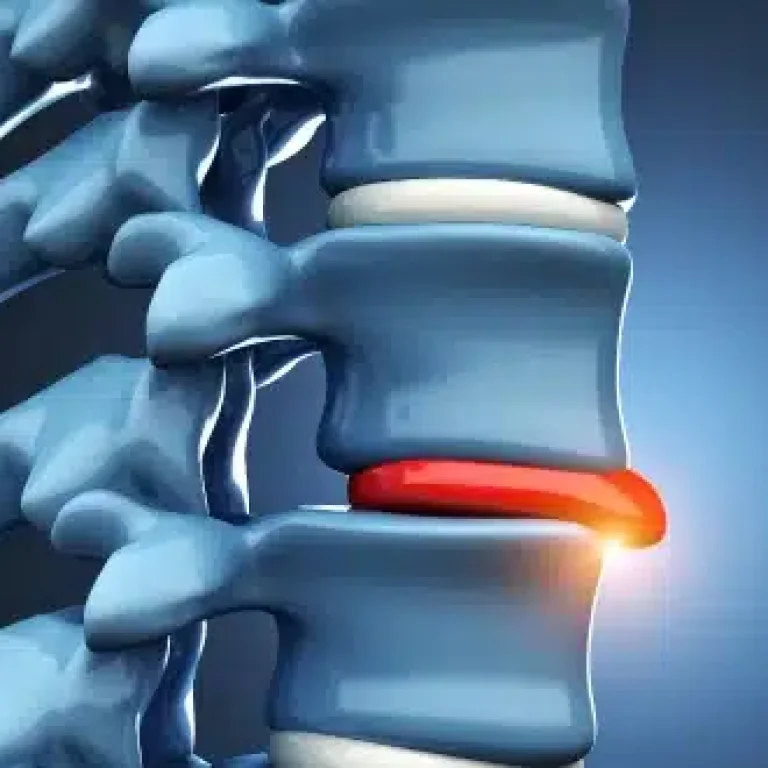 Slipped-Disc