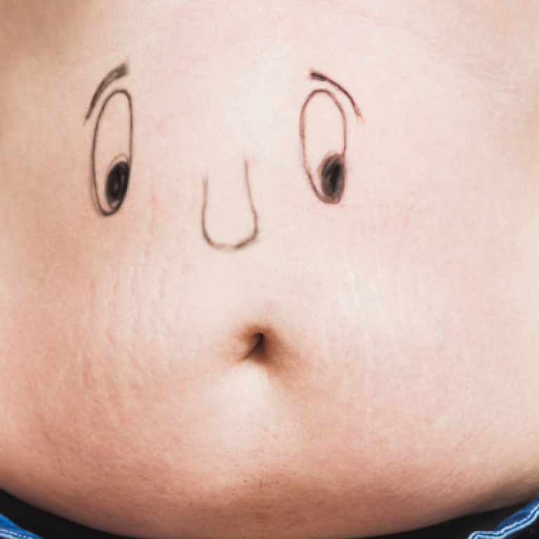 Close-up of a person's belly with a sad face drawn around the navel, symbolizing stomach discomfort, bloating, or issues like navel dislocation.