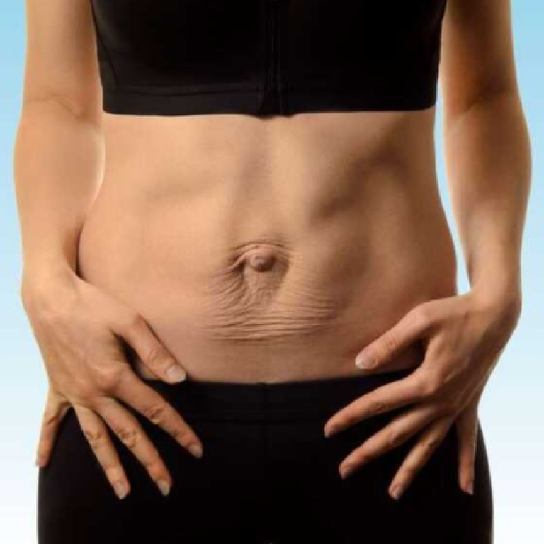 A person showing their abdominal area with visible signs of muscle weakness or misalignment, possibly related to navel displacement. The image highlights the impact of abdominal strain on core stability and posture.